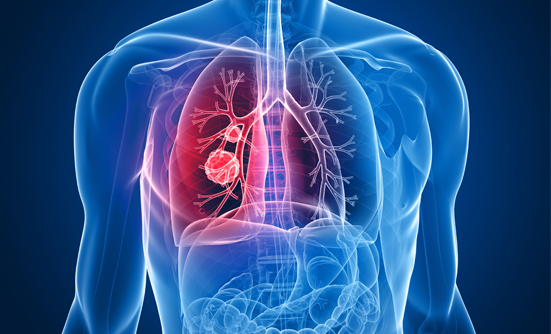 What You Need to Know About Lung Cancer
