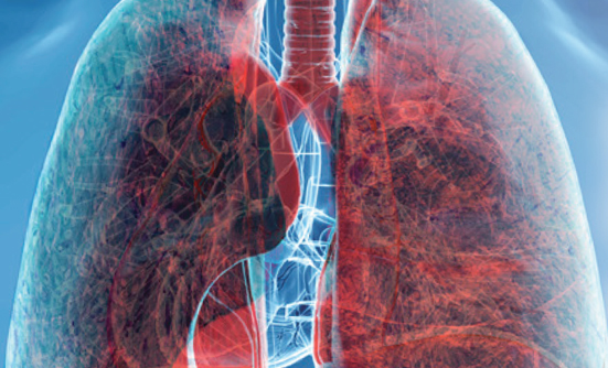 New Immunotherapy Combination Improves Survival in Advanced NSCLC