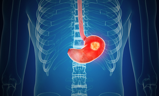 Lonsurf Approved for Metastatic Gastric or Gastroesophageal Junction Cancer 