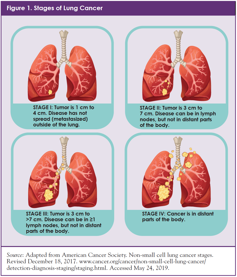 The Different Types Of Lung Cancer - vrogue.co