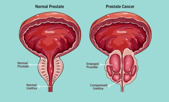 Prostate Cancer Overview: Diagnosis, Treatment, and Self-Care