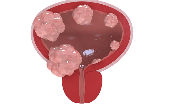 New Immunotherapy Drugs Are Making Headway in the Treatment of Bladder Cancer