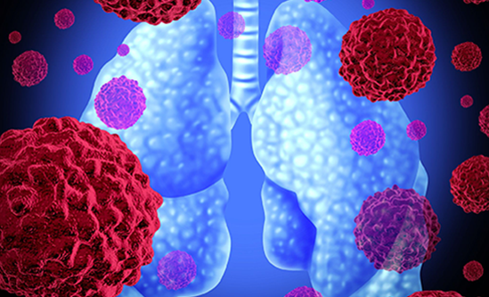 Immunotherapy Drugs Extend Survival of Patients with Lung Cancer